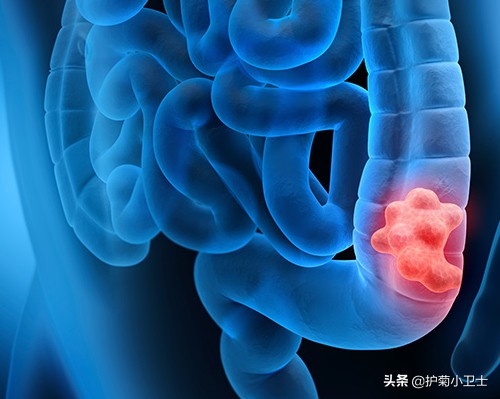 便血别担心不一定是直肠癌,便血不一定是肠癌吗