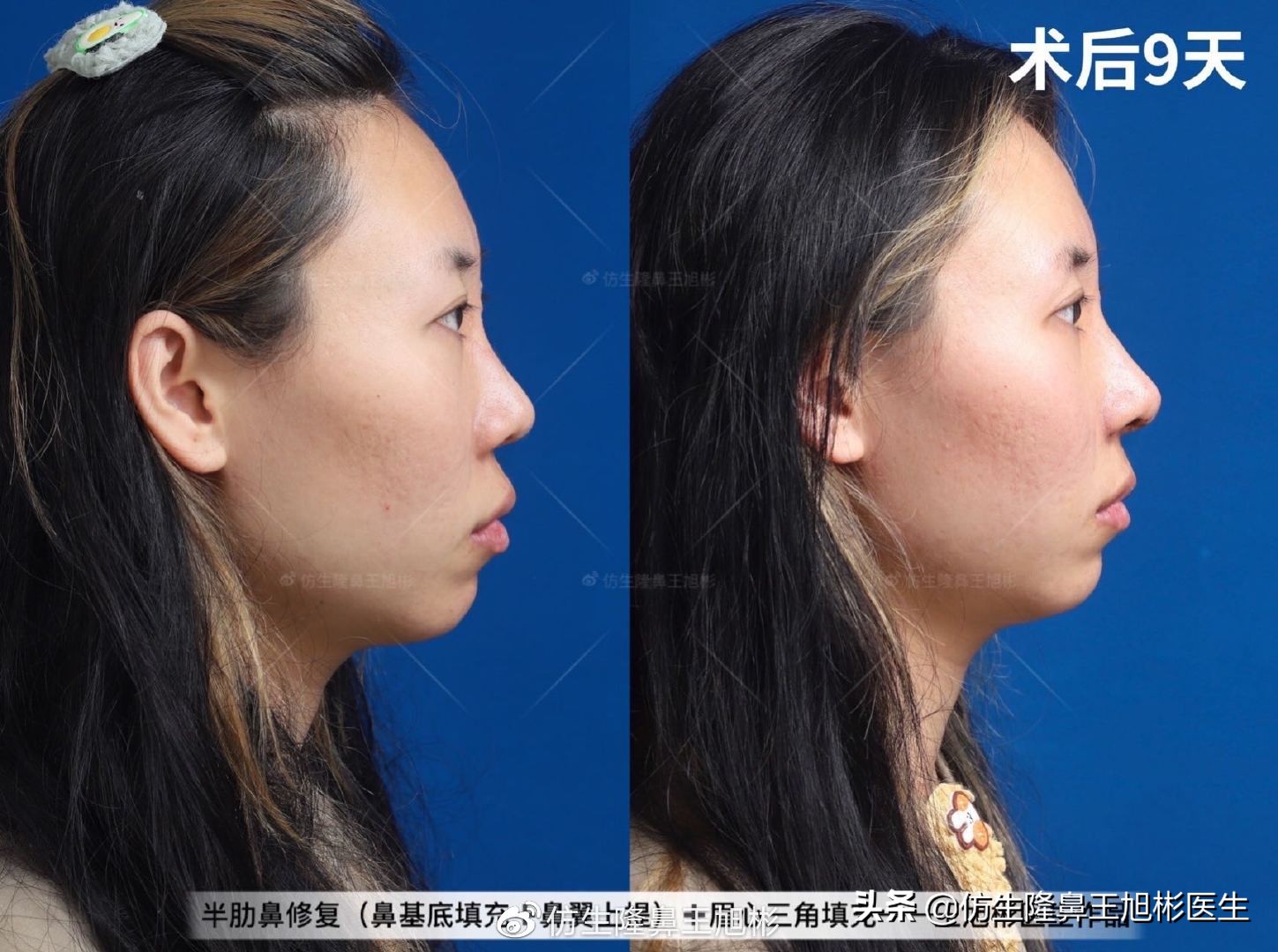 常见鼻部整形美容项目,整形鼻和自然鼻