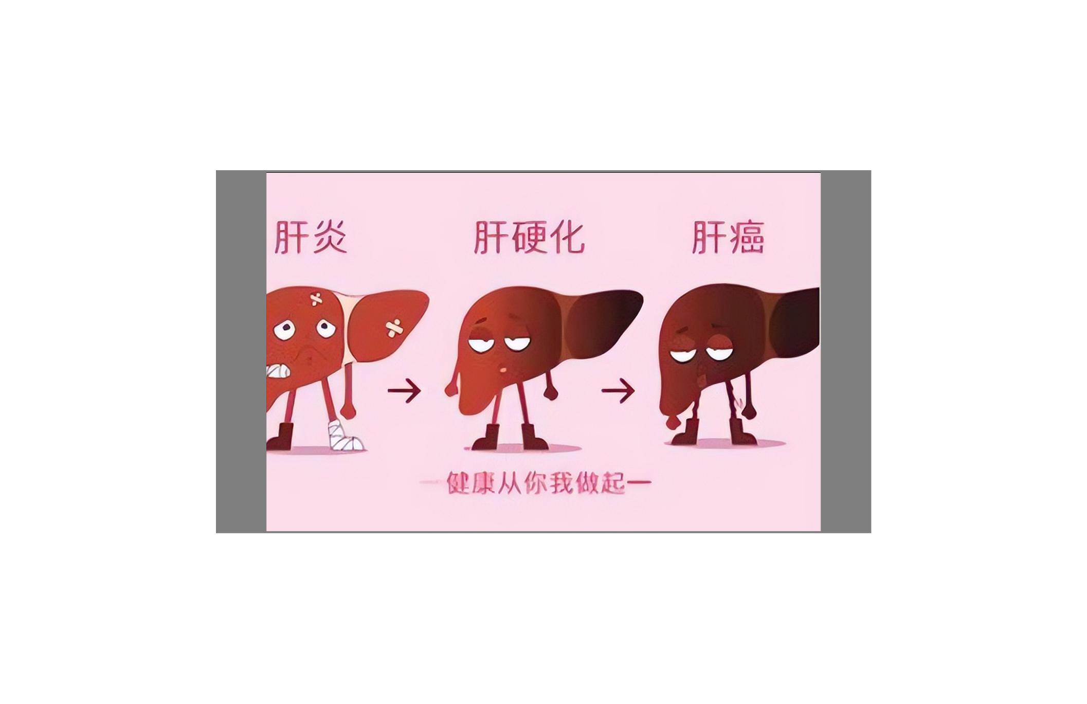 抗病毒后进展为肝硬化的几率大吗,抗病毒治疗后甲胎蛋白升高