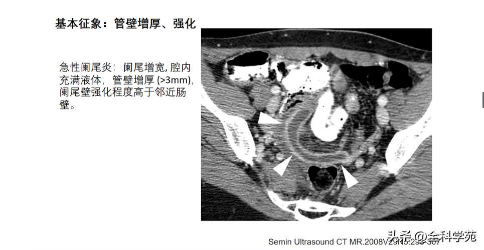 阑尾炎的讲解,关于阑尾炎的讨论总结