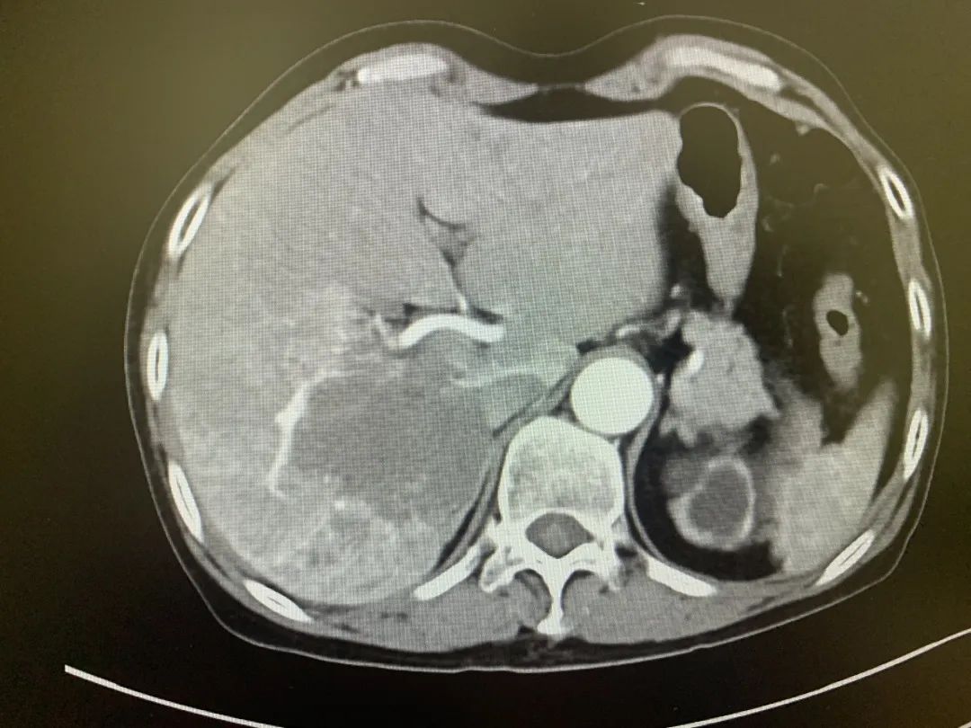 肝癌治疗出现奇迹,肝癌精准治疗
