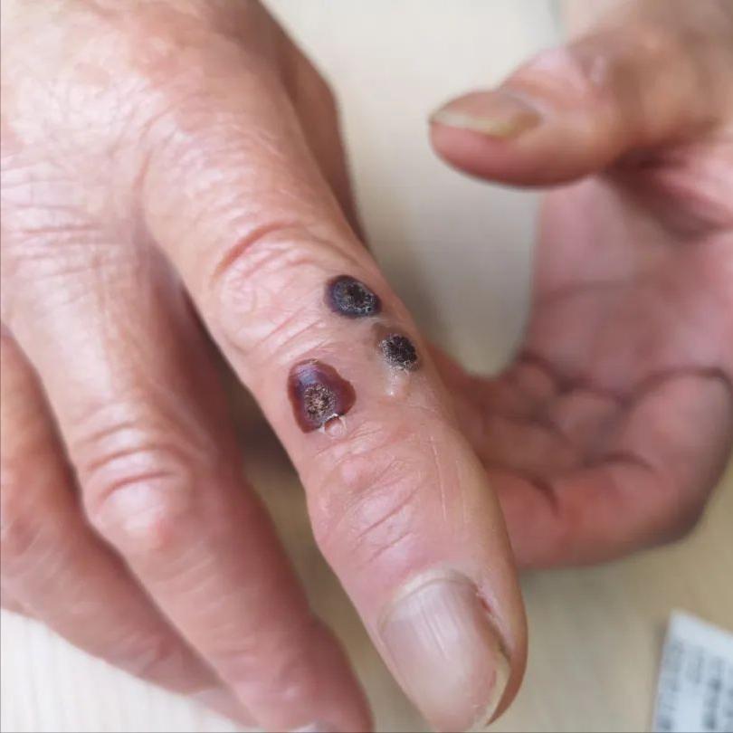 hpv病毒引起的疣是什么,hpv引起的病毒疣