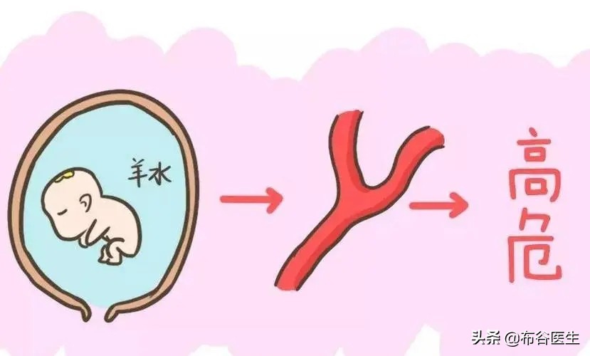 羊水栓塞怎么办呢,羊水栓塞怎么读