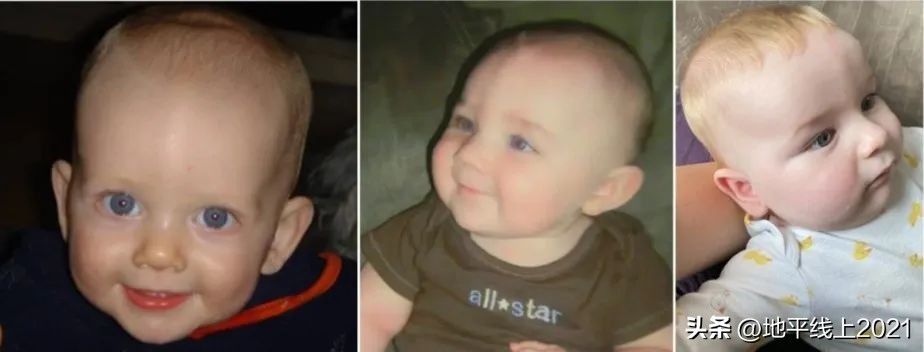 额头上凸起的像犄角一样怎么改善,婴儿额头突出有犄角