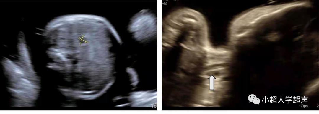 超声影像小视频,食道闭锁超声表现