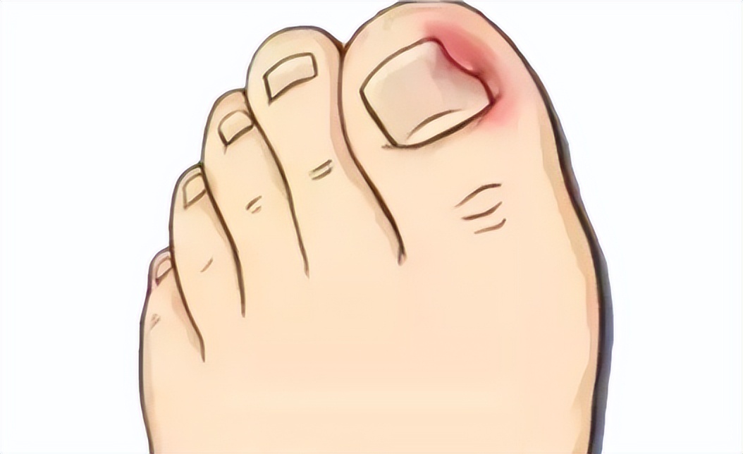 一走路脚趾甲里疼怎么回事,甲沟炎拔完脚趾甲很疼怎么办