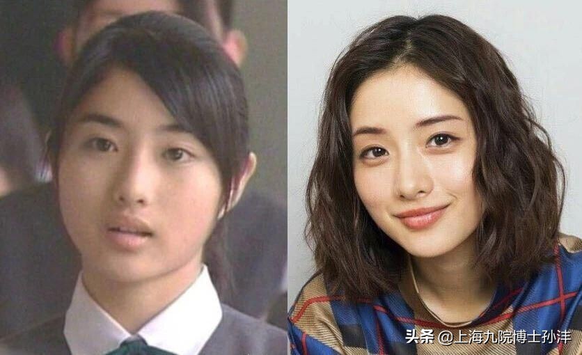 一般做个眼综合双眼皮多少钱,双眼皮和眼综合的区别图片