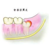 健康科普龋齿涂氟,一分钟看懂智齿的秘密