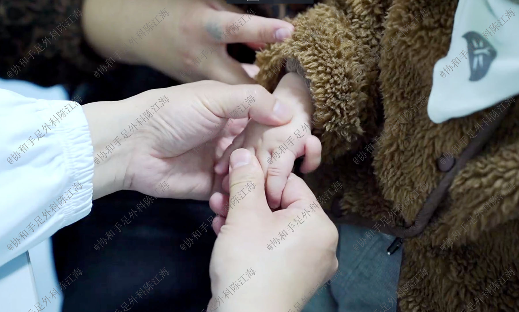 漂浮指治疗的最佳方法,漂浮拇指手术好不好做