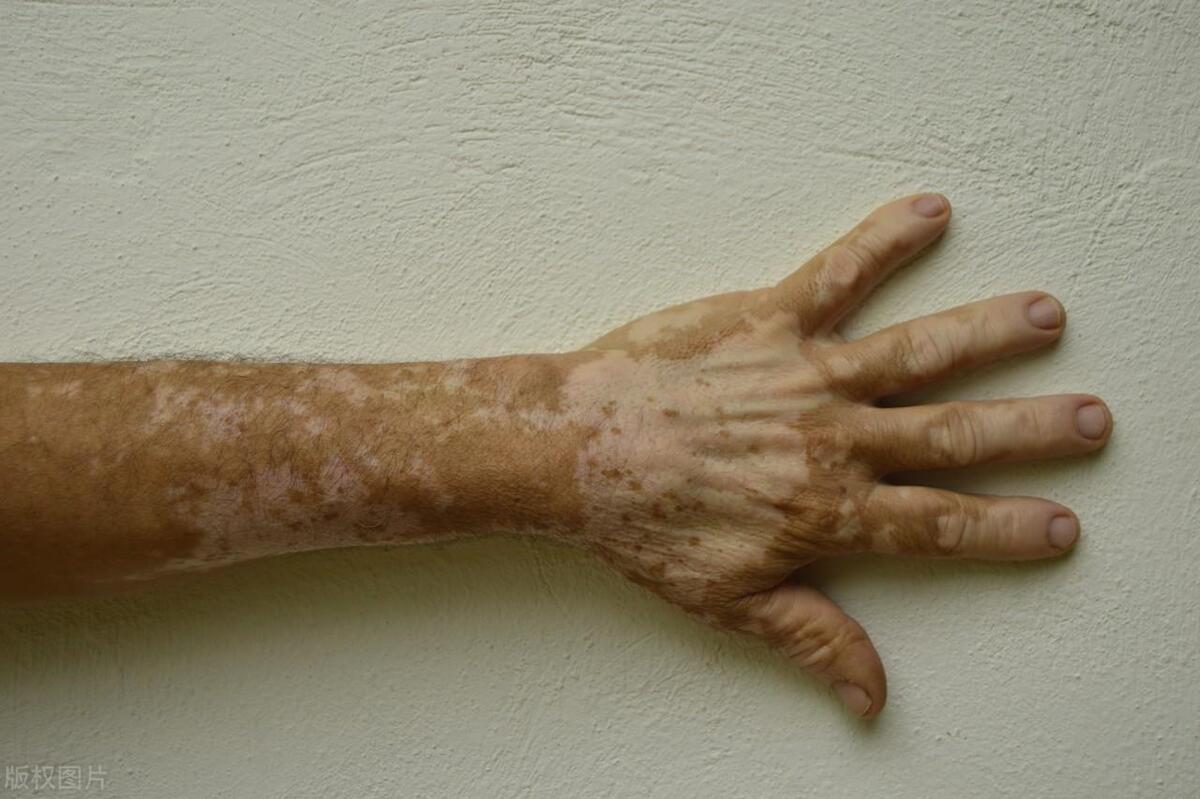 涨知识关于健康,医生说晒太阳后如何快速变白