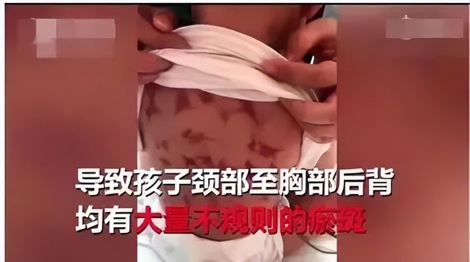 9岁儿童高烧不退盖被子又说太热,孩子发高烧医生建议住院一个星期