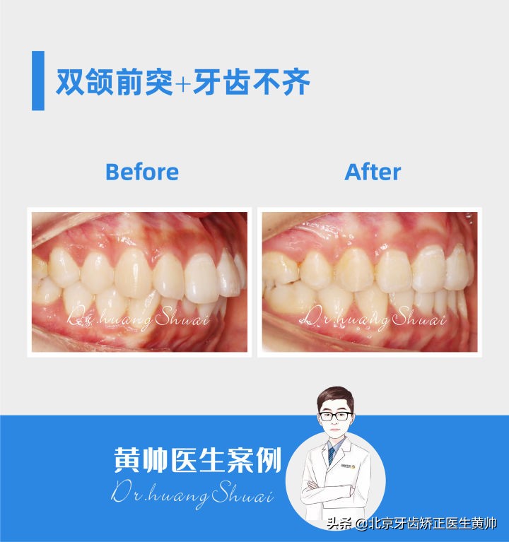 嘴凸的人怎么笑起来好看,嘴凸怎么让自己不焦虑