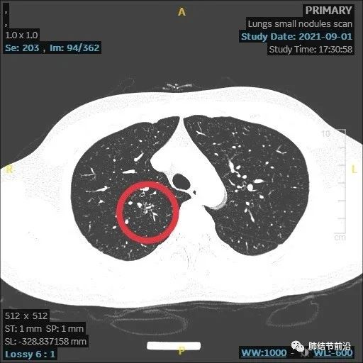 炎症引起的肺实性结节生长速度,肺部结节影像学读片讲解视频