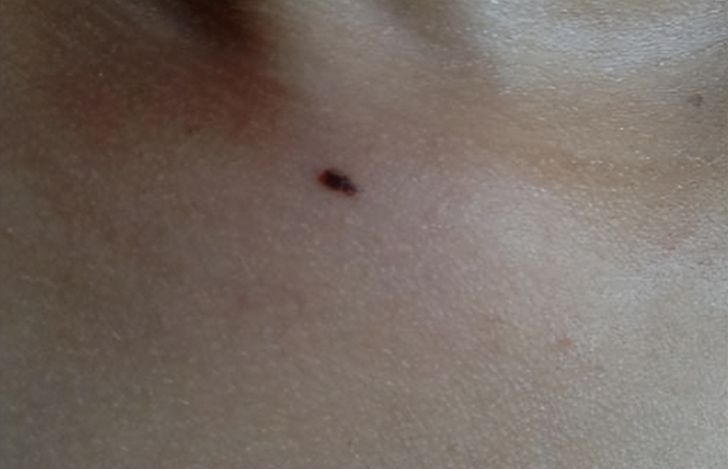 黑痣长在脸上各部位代表什么图片,医生说黑痣有癌变的可能怎么办