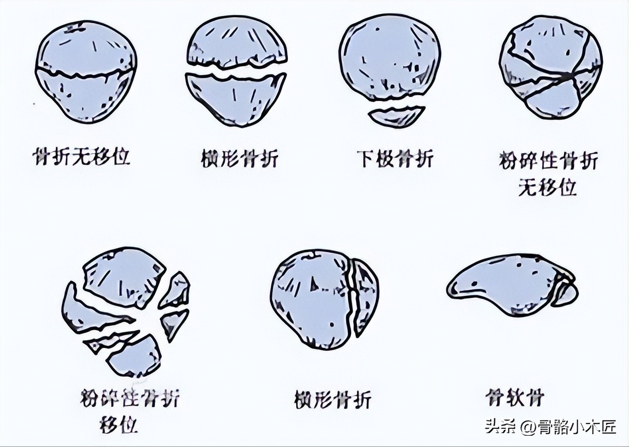 髌骨骨折练弯曲最佳时间,髌骨骨折90%都会留下后遗症吗