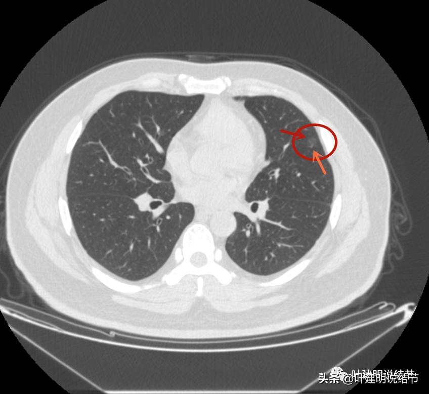 如何判断肺磨玻璃结节是高危结节,肺上有混合磨玻璃结节要注意什么