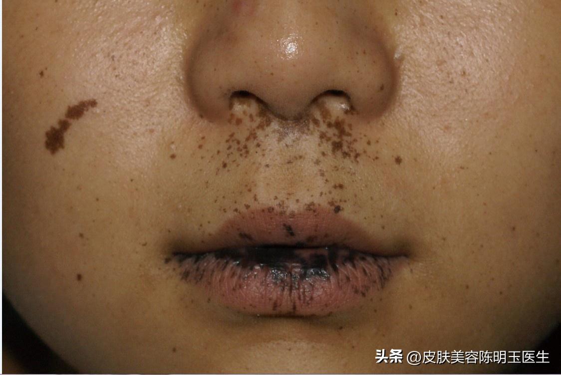 嘴唇上长黑痣好不好有啥说法,嘴唇长黑痣可以去除吗