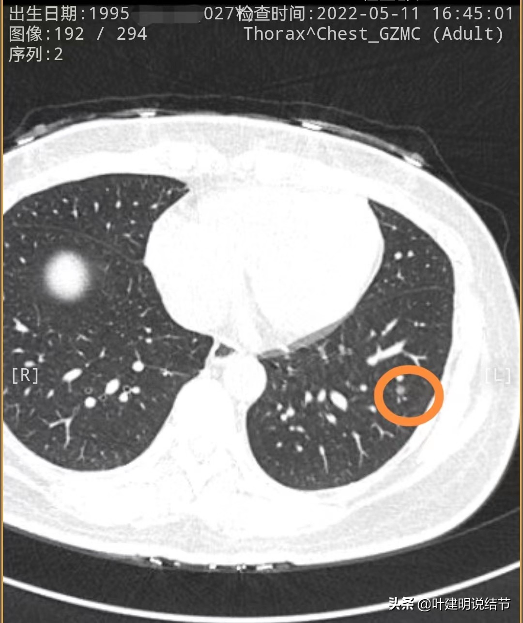 27岁女博士查出肺癌,年轻人多发肺结节怎么治愈