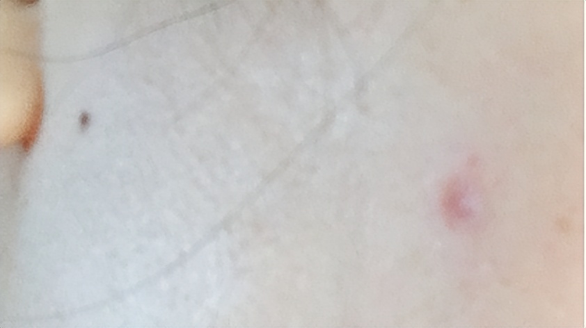 人各有“痣”，长在这些部位的痣易癌变！ABCDE法自测危险程度