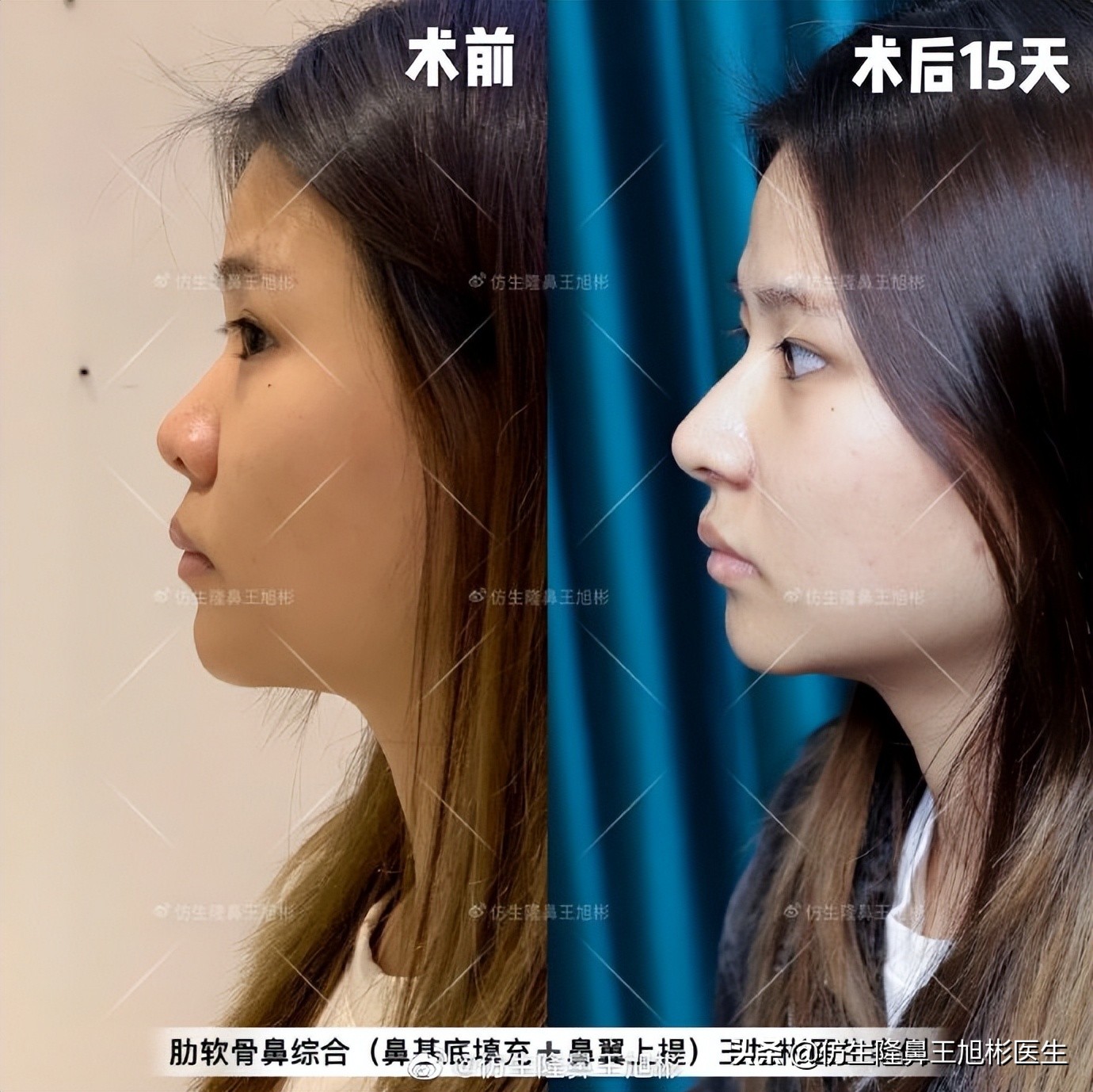 做一次鼻头缩小要多少钱好,可以只做鼻头缩鼻翼吗