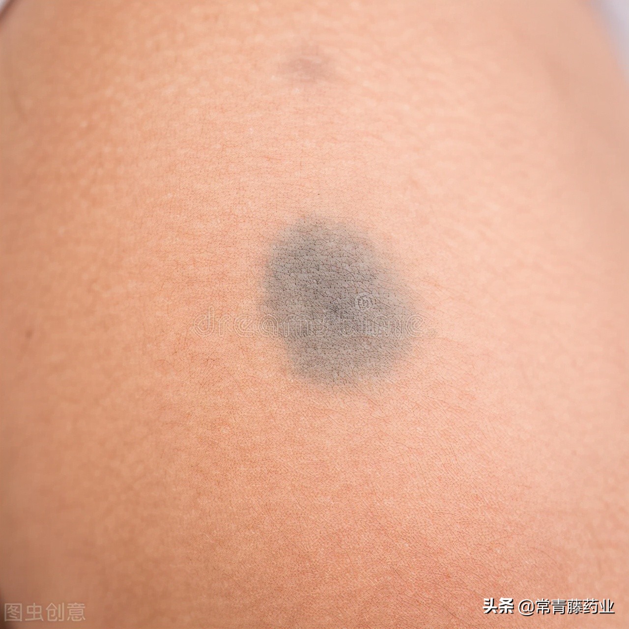 雀斑晒斑各种斑都是怎么形成的,色斑雀斑晒斑的区别