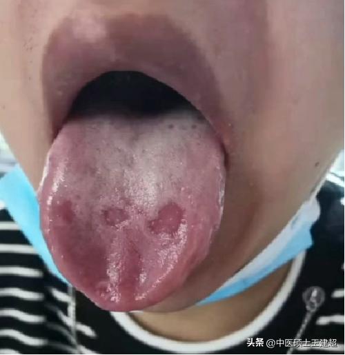 爱出汗是脾虚怎么调理,脾阴不足的舌苔