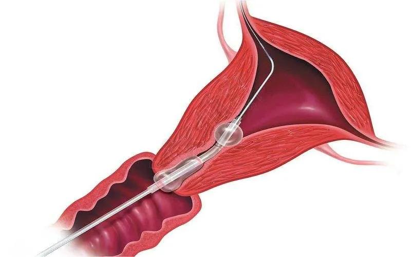 妇科医生讲述真实故事,妇产科手术室里的故事