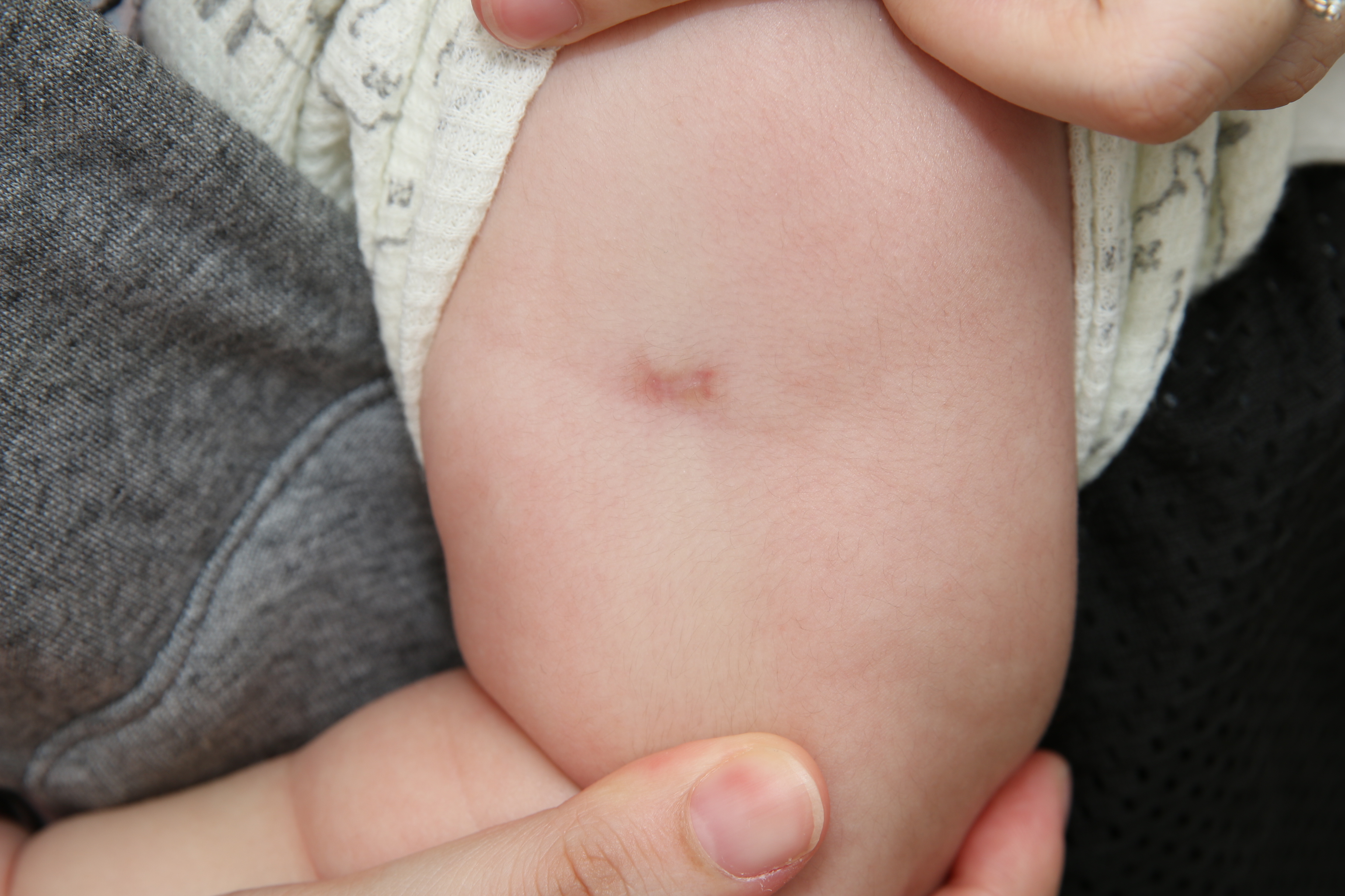 卡介苗接种后为啥有不良反应?