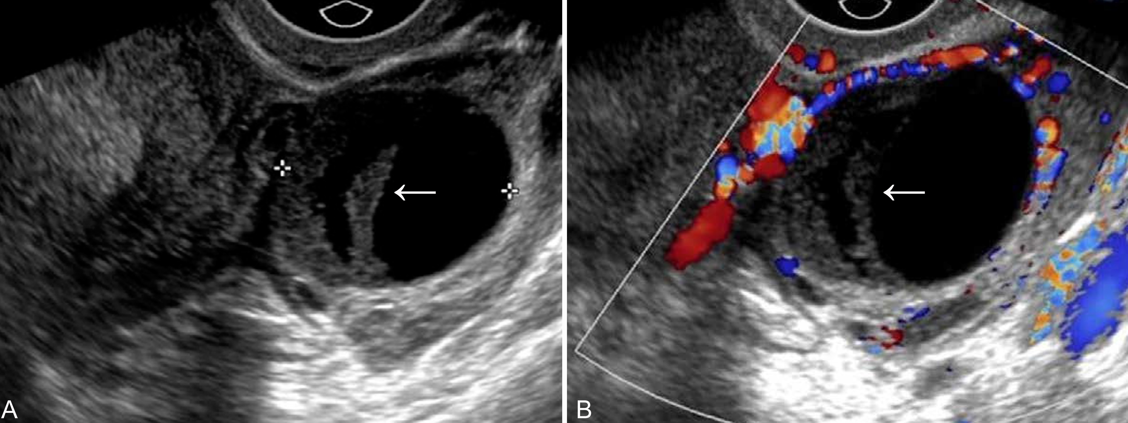 卵巢结节怀孕后变成黄体囊肿,怀孕初期超声有黄体囊肿血流信号