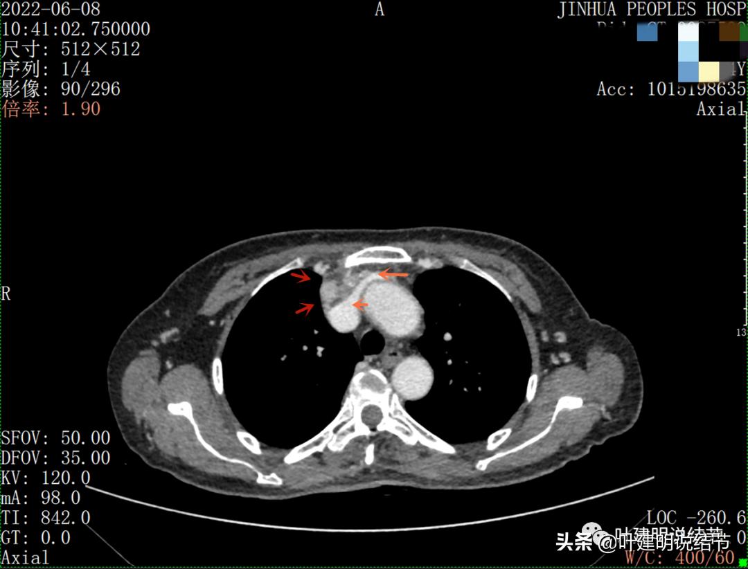 这位老乡，乏力来查，查出这么大个的纵隔肿瘤！会是什么呢？