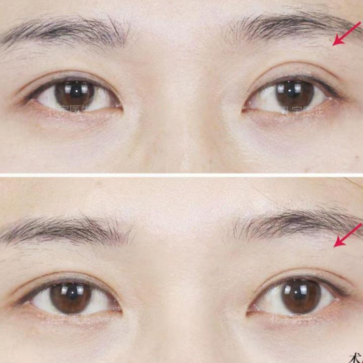 修复假宽深双眼皮最好的医院,双眼皮做宽了显老怎么补救