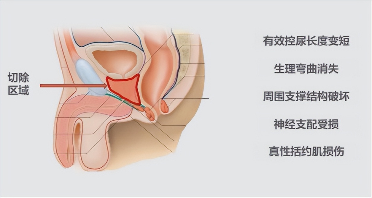 阴部神经电针刺激联合盆底肌锻炼治疗前列腺癌术后尿*禁失**