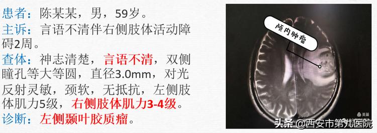 胶质瘤影像研究进展,胶质瘤核磁影像强化