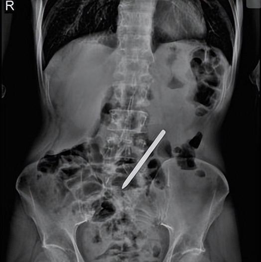 男子吃下10厘米螺丝刀杆，强忍腹痛4月，如今竟然活得好好的！