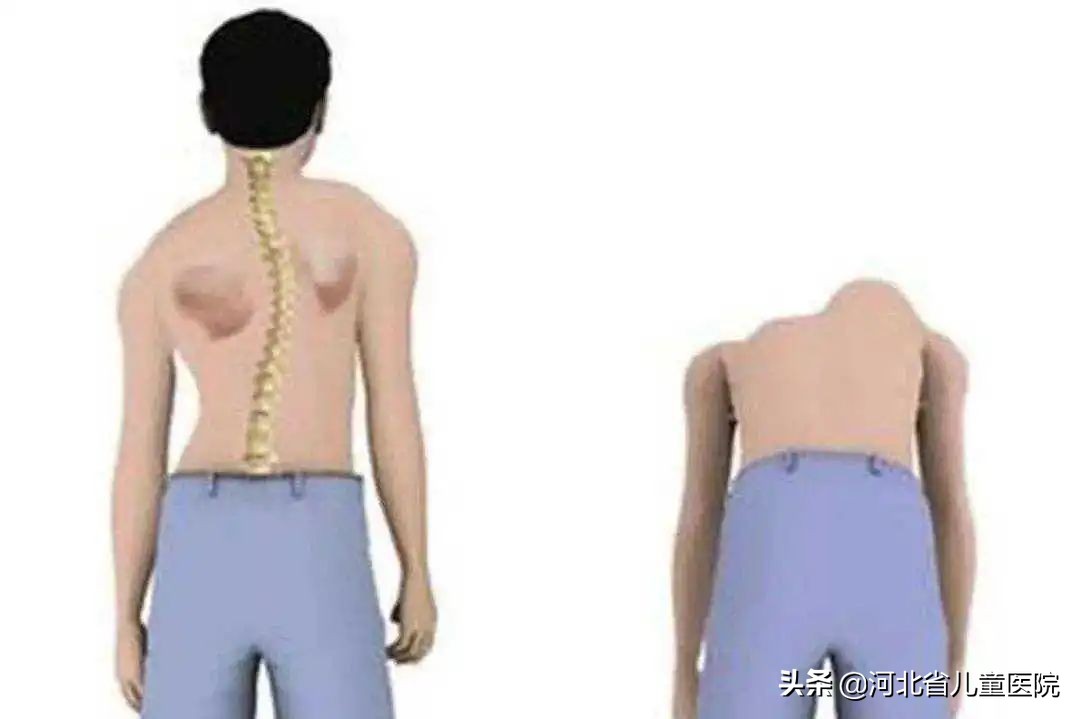 孩子的肩膀一个高一个低怎么回事,孩子肩膀一高一低怎样调节