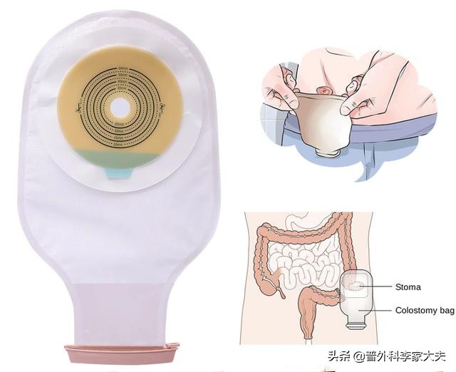结直肠癌术后肠瘘患者，作为医生的我，已难以承受术后风险了