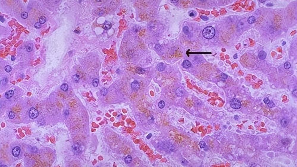 牙膏祛老年斑最好的克星,牙膏能去除老年斑是真的吗