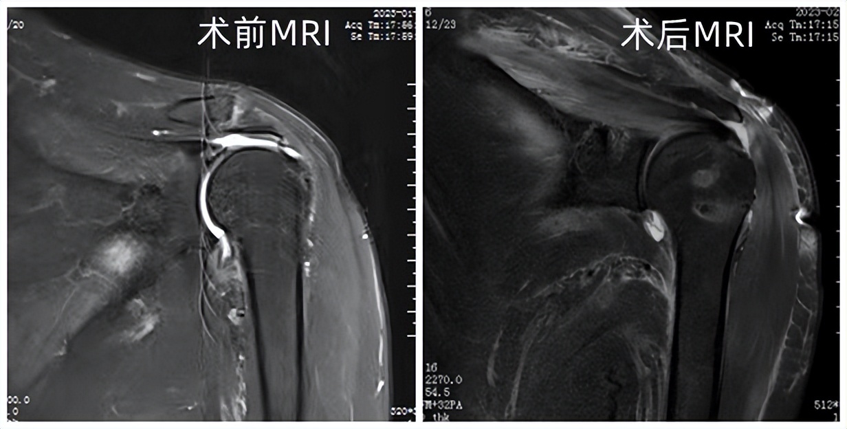 肩袖损伤微创手术还是没好怎么办,肩袖损伤了不治能抬多高