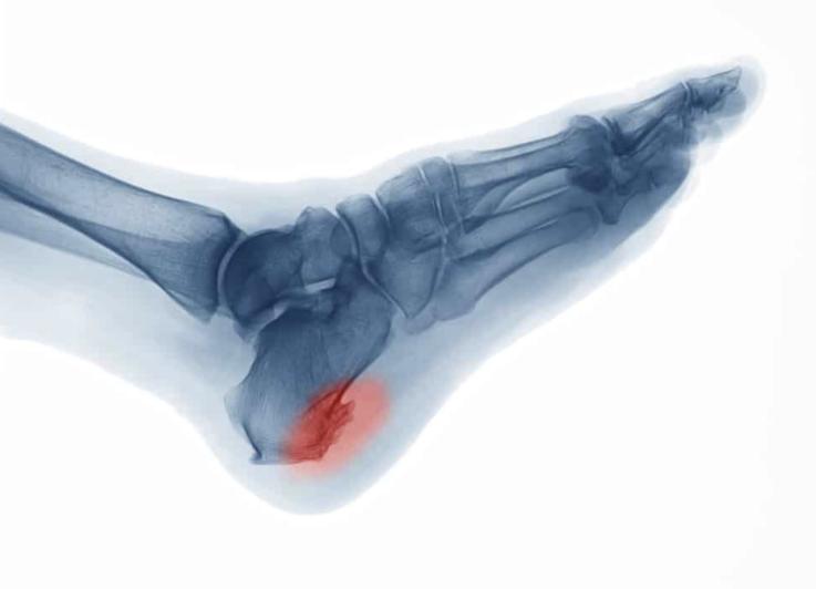 脚后跟疼的原因和治疗的方法,引起脚后跟疼痛的常见11种疾病