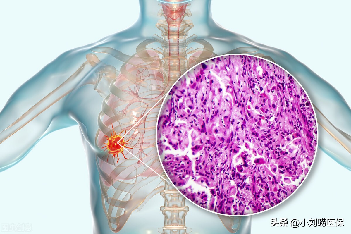 医保报销比例超过70%，一些癌症靶向药普通门诊和药店也可以报销