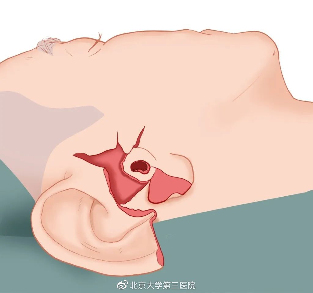 意外留疤怎么安慰,眉尾意外受伤留疤好不好