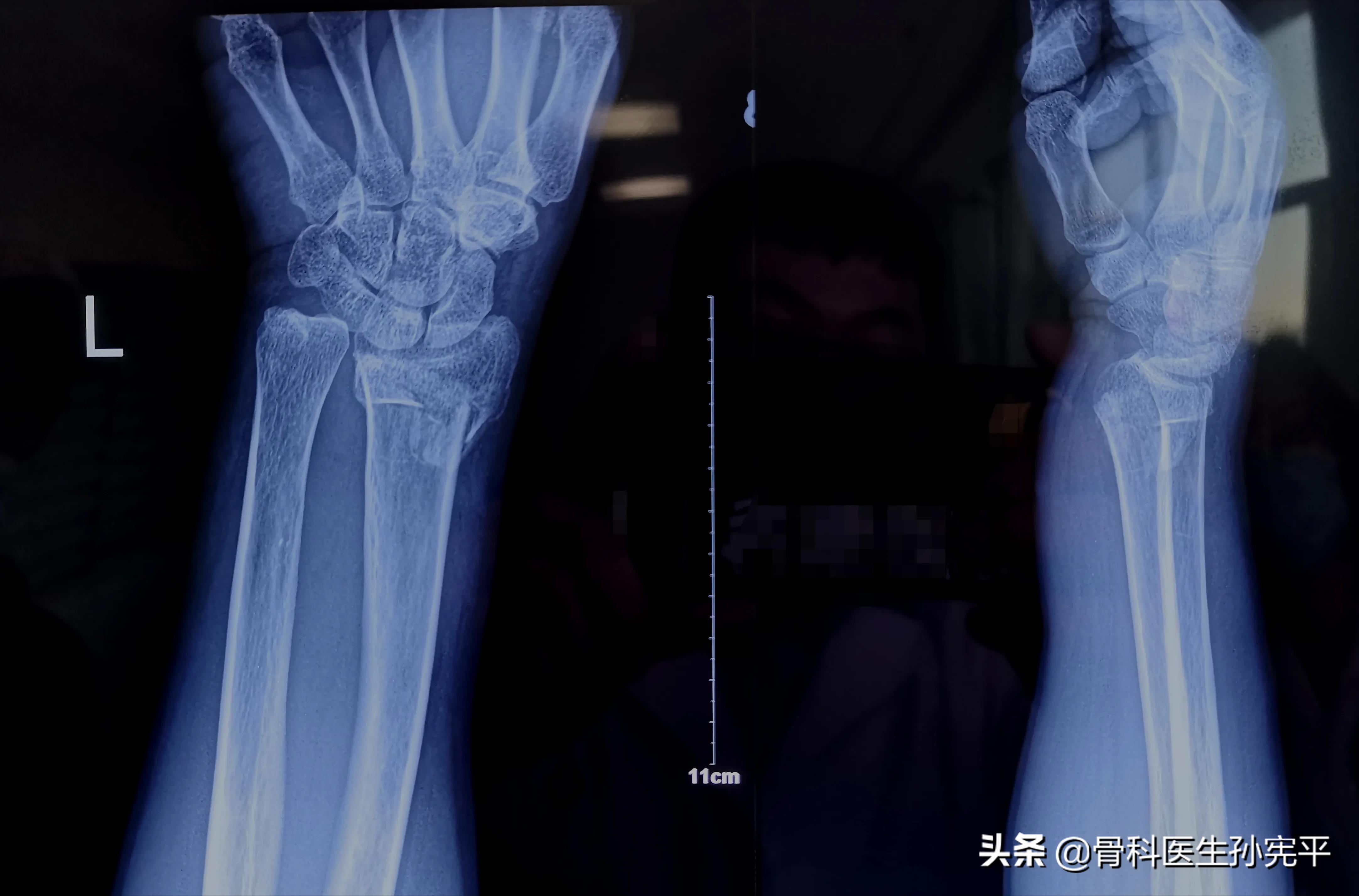 桡骨近端骨折和远端骨折哪个严重,桡骨远端骨折属于colles骨折吗