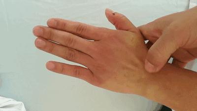 医圣张仲景发明的活血化瘀第一方,张仲景治疗结节囊肿的方子