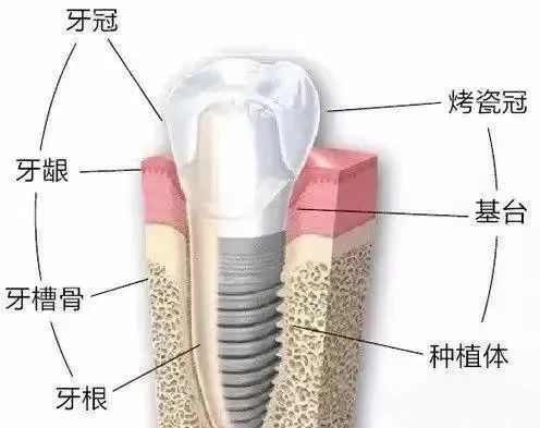 全瓷牙和烤瓷牙相比哪个更结实,全瓷牙和烤瓷牙哪个质量好一点
