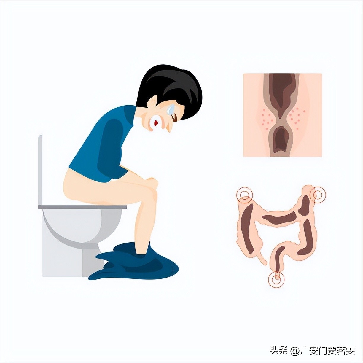 肛门瘙痒到底是什么原因引起的,肛门瘙痒是什么原因引起的怎么治