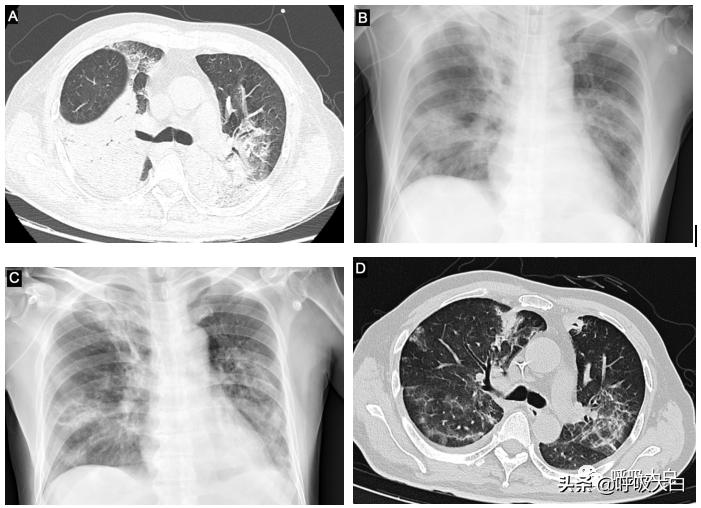 鹦鹉热病例分享,鹦鹉热怎么用药