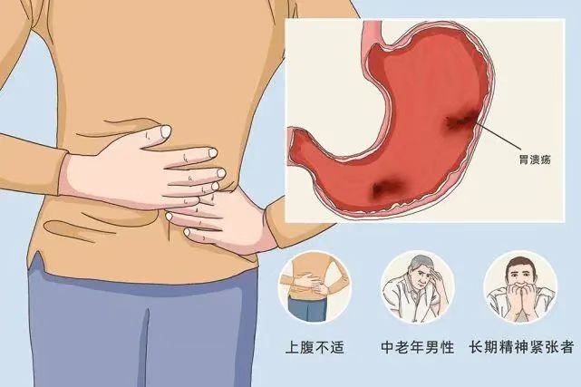 消化科胃溃疡科普视频,消化性胃溃疡医生怎么说