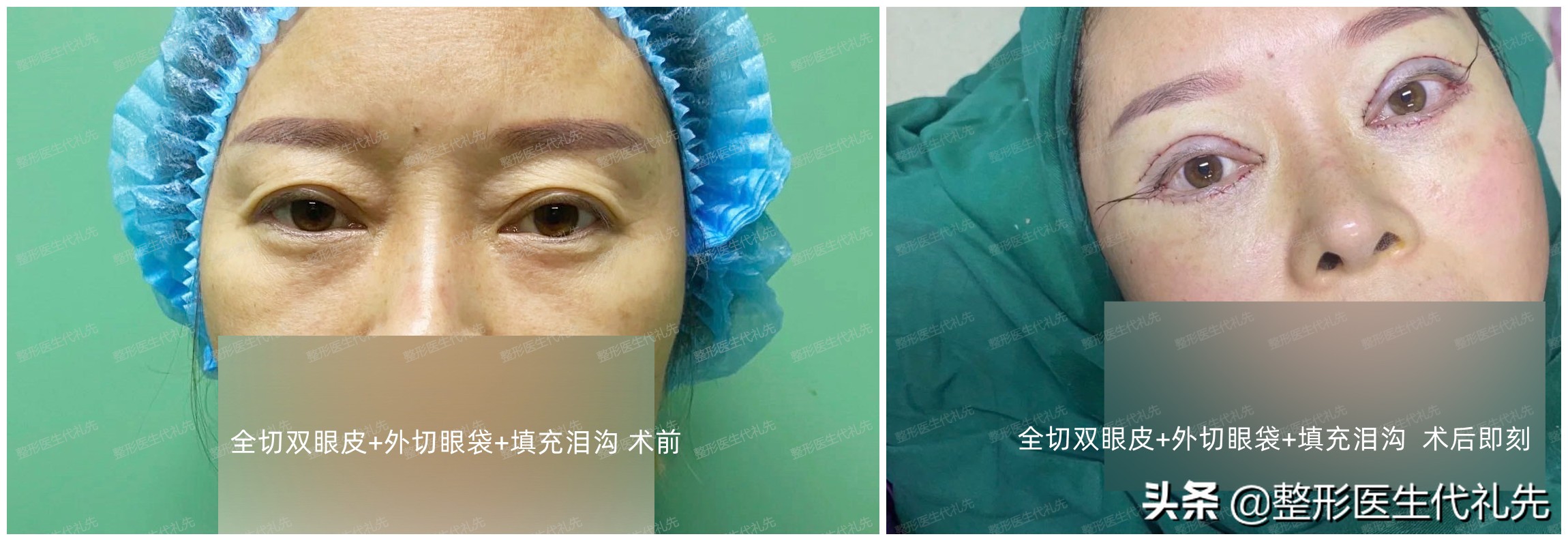 五十岁割双眼皮祛眼袋,40岁小眼睛全切双眼皮效果