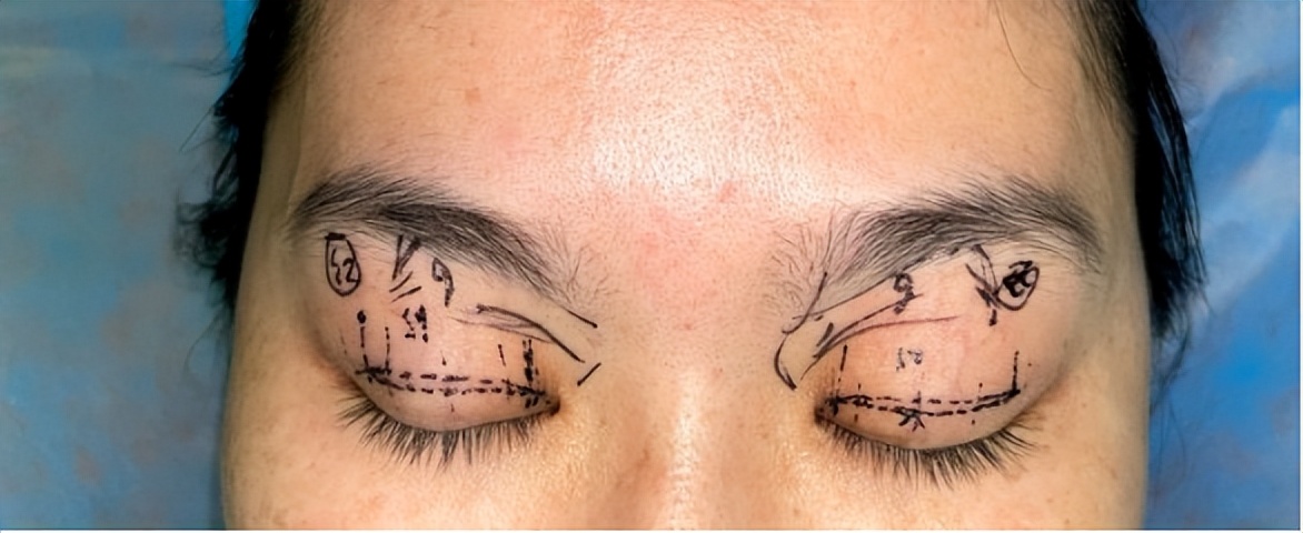 整形双眼皮失败案例,广州宝妈产后修复