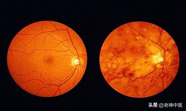 糖尿病视网膜病变眼底出血严重吗,糖尿病眼底出血黄斑病变怎么治